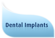Dental Implant